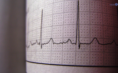 Management of Tarchyarrthymias CME