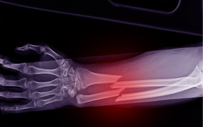 Principles of Fractures in Children CME